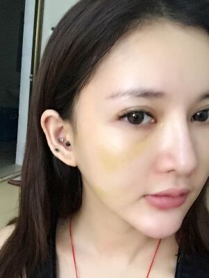 筋膜悬吊除皱术 让你青春永驻