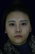 23岁女孩下颌角过大整形真实案例恢复录 width=