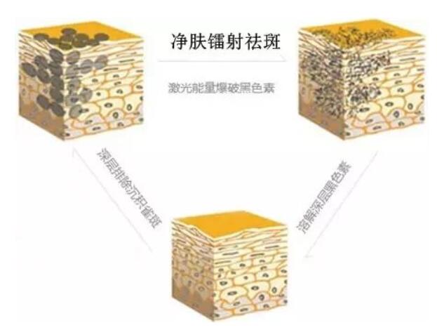 镭射净肤