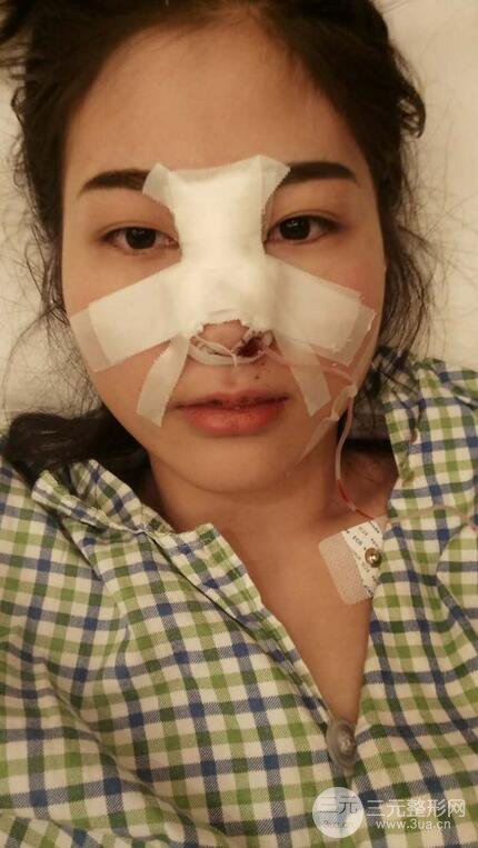 自体软骨隆鼻有后遗症吗?
