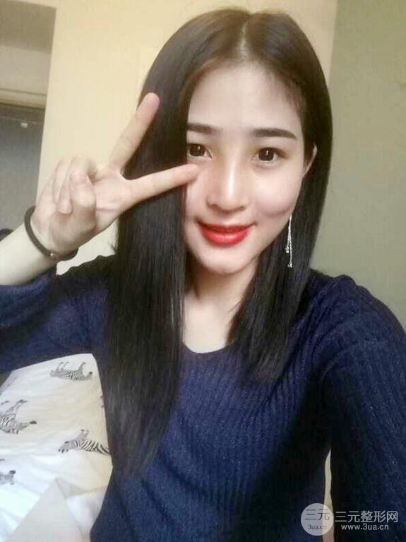 自体软骨隆鼻有后遗症吗?