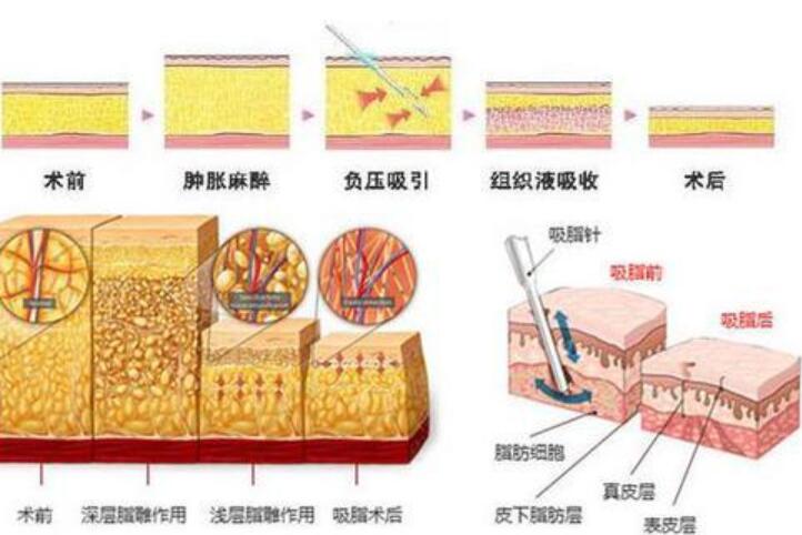 360度环形吸脂减肥