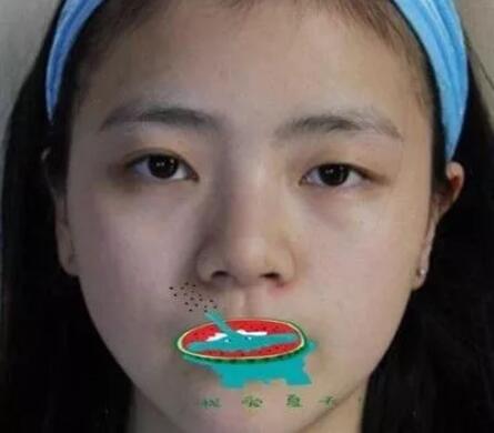 打注射瘦脸前后对比图，心机闺蜜想坑她?!