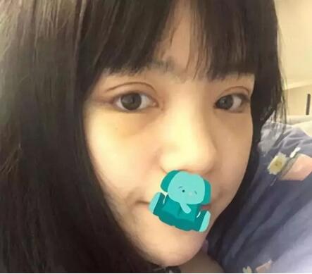 打注射瘦脸前后对比图，心机闺蜜想坑她?!
