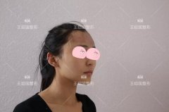 王绍国医生怎么样|爱多邦额头取出案例~ width=