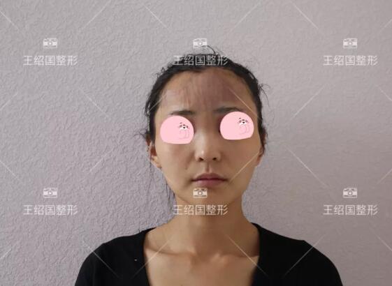 【王绍国很厉害吗|爱多邦取出案例】