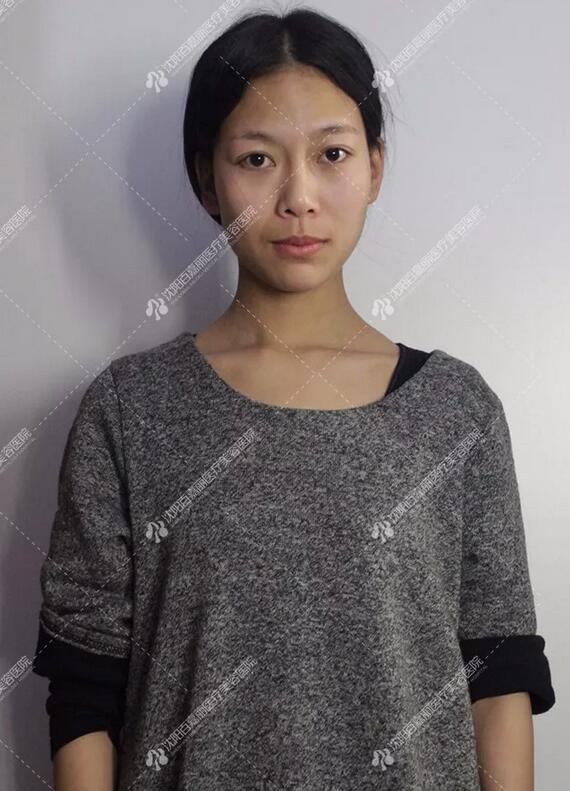 内窥镜德国vizaar威萨隆胸案例一则，你******憋拒绝！
