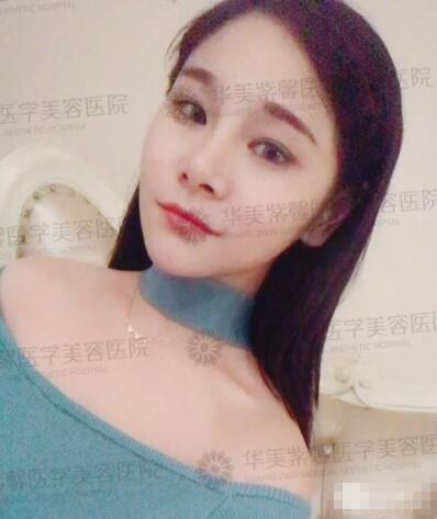 下颌角接骨整形技术好吗?她用经历告诉你!