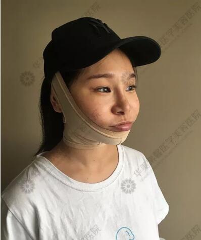 下颌角接骨整形技术好吗?她用经历告诉你!