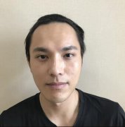 大连沙医生男人发际线种植180天后，颜值呈直线上升 width=