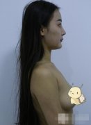 假体丰胸李朕在线咨询：假体丰胸真实案例恢复分享 width=