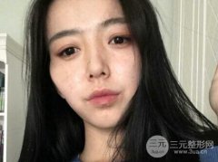 俞良钢颧骨内推怎么样？这则案例果告诉你！ width=