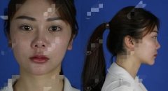 巫文云隆鼻修复怎么样？巫文云隆鼻修复案例来说话！ width=