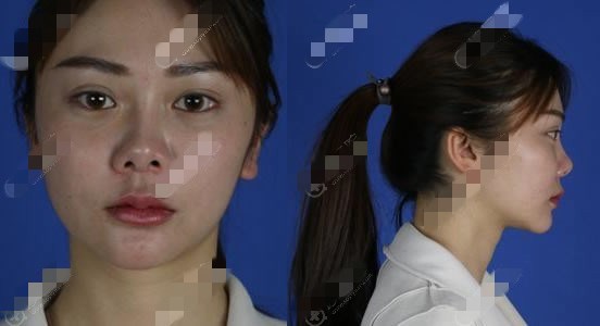 巫文云隆鼻修复