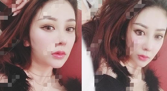巫文云隆鼻修复