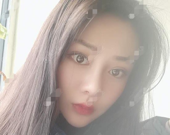 巫文云隆鼻修复