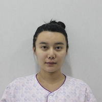 驼峰鼻修复价格多少?想了解的请转过脑袋看过来