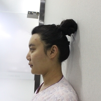 驼峰鼻修复价格多少?想了解的请转过脑袋看过来