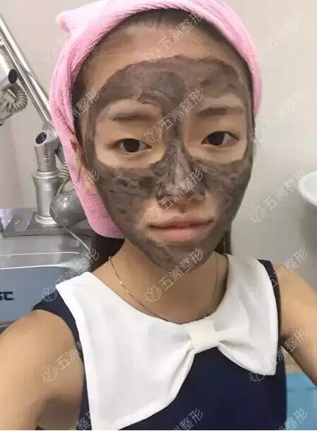 黑脸娃娃的功如何，重庆五洲整形真实案例为你解答