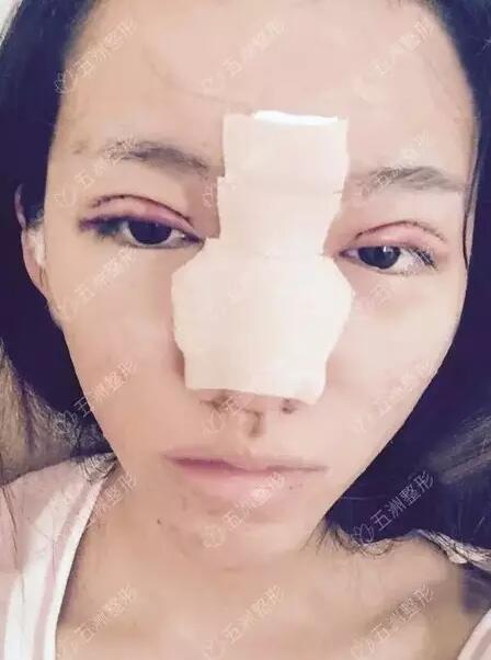 黑脸娃娃的功如何，重庆五洲整形真实案例为你解答