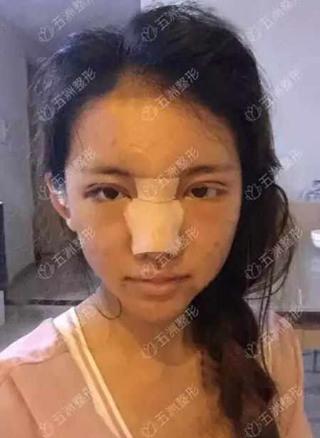 黑脸娃娃的功如何，重庆五洲整形真实案例为你解答