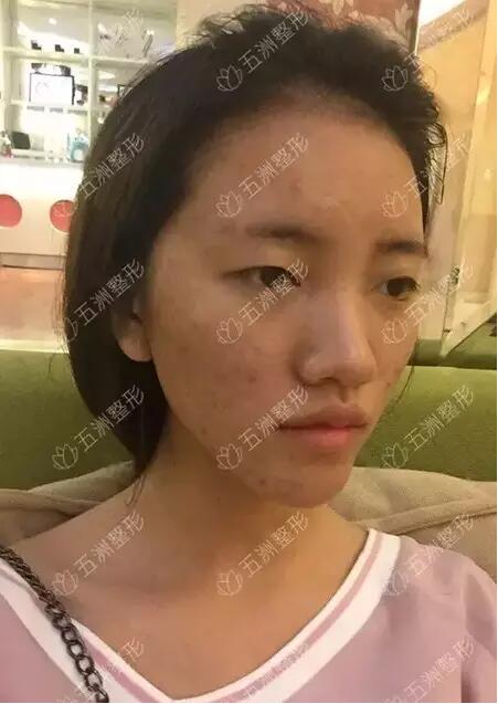黑脸娃娃的功如何，重庆五洲整形真实案例为你解答