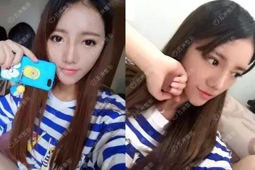 黑脸娃娃的功如何，重庆五洲整形真实案例为你解答
