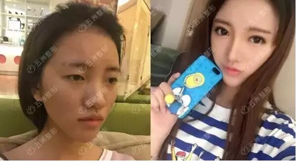黑脸娃娃的功如何，重庆五洲整形真实案例为你解答