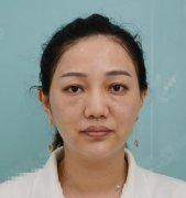 成都美雅娜玻尿酸除鱼尾纹果案例展示，你能看出这是40岁的脸? width=