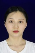常州美贝尔磨骨手术对比照片案例 63天的真实恢复过程 width=