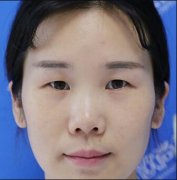 杜大夫整形芭比眼真人案例对比图|32天从一个有魅力的女银 width=