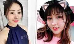 自体脂肪填充颞部果好吗？两位小姐姐案例告诉你！ width=