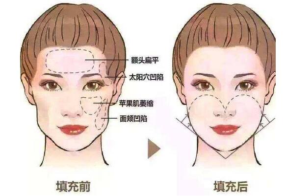 面部脂肪填充要多少钱呢？