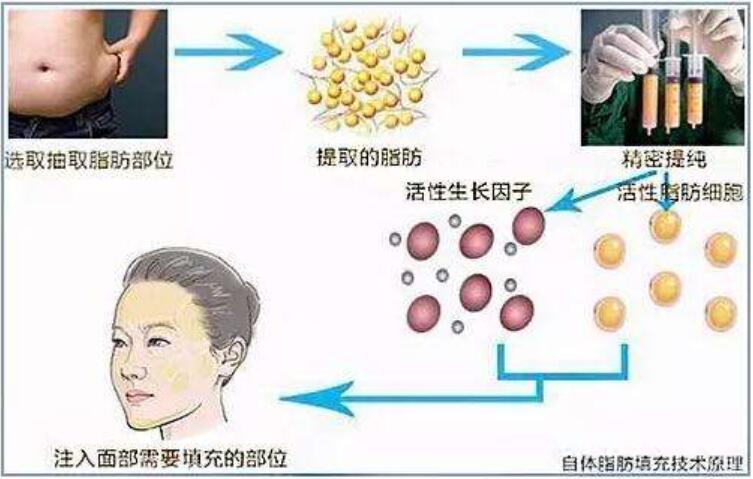 面部脂肪填充要多少钱呢？