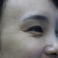 去鱼尾纹多少钱?成都西婵整形医院为你做专业解答