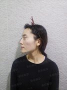 刘中国自体脂肪丰面颊35天恢复从骷髅脸变成圆润日系女孩~ width=