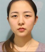 陈逸华割双眼皮案例这么自然，立马安排她! width=