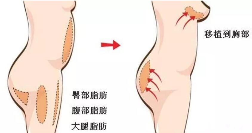 【没问题隆胸术本应该是怎样的|切忌盲目隆胸酿大错！】