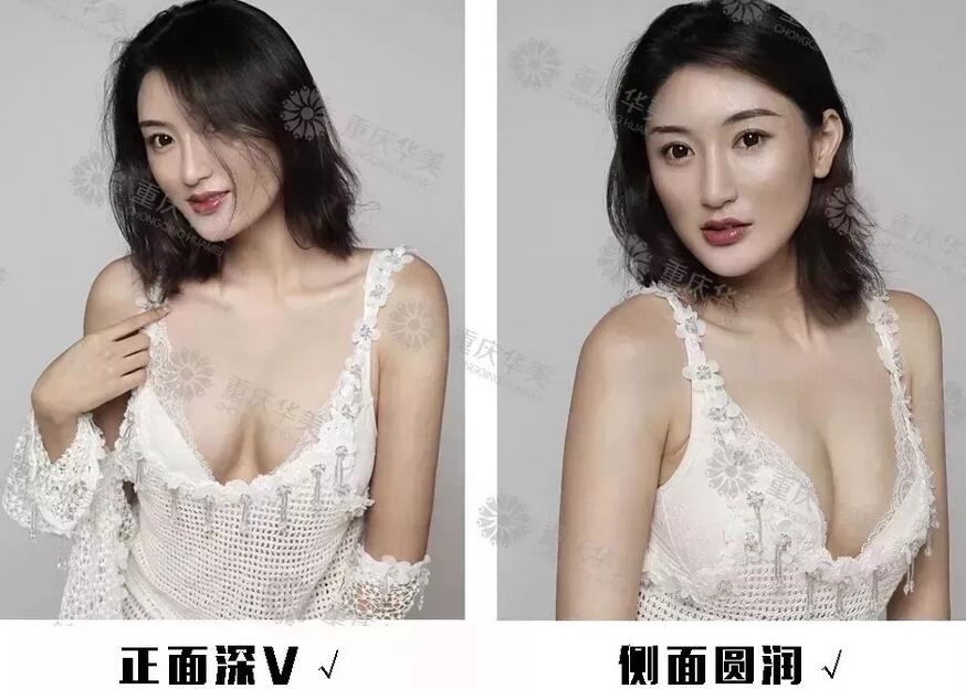 【没问题隆胸术本应该是怎样的|切忌盲目隆胸酿大错！】