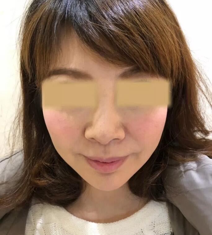 隆鼻专用acmetea是什么？我的经历为你详细揭秘~