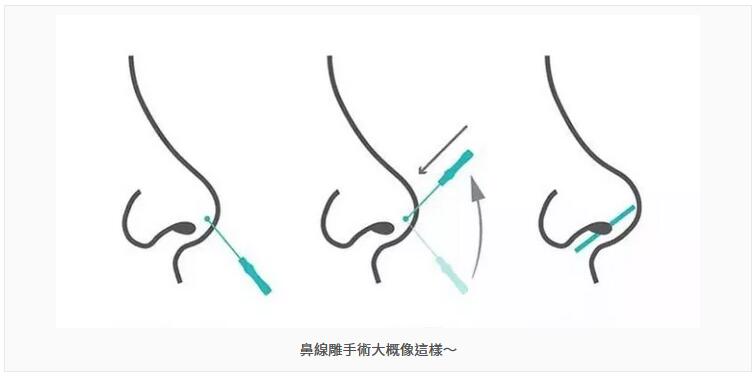 隆鼻专用acmetea是什么？我的经历为你详细揭秘~