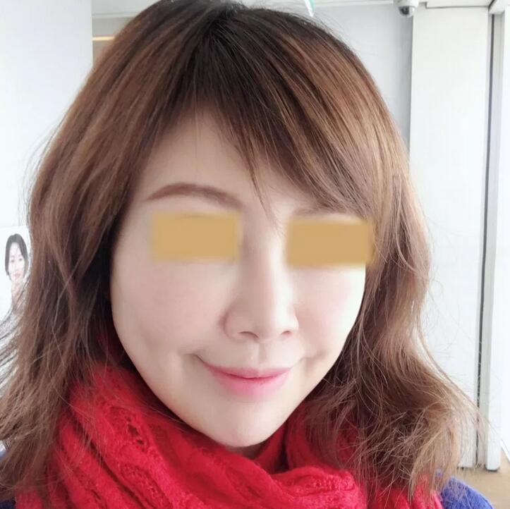隆鼻专用acmetea是什么？我的经历为你详细揭秘~