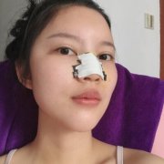 唐山美联臣价目表【朝天鼻矫正案例恢复记录】 width=