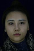 实战下颌角接骨整形技术恢复197天后，攻克世纪难题 width=