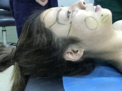 汕头伊丽莎白整形医院价目表【鼻部手术真实案例对比图分享】 width=