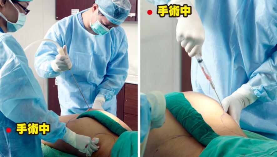 360吸脂减肥大致多少钱