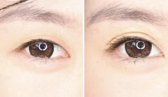 韩式or欧式双眼皮哪个适合你?分别适合哪些人? width=