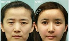 光波拉皮有什么危害?能避免吗? width=