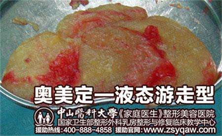 奥美定取出