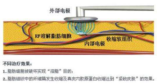 光纤微创溶脂大概多少钱?听说贵得有点离谱?